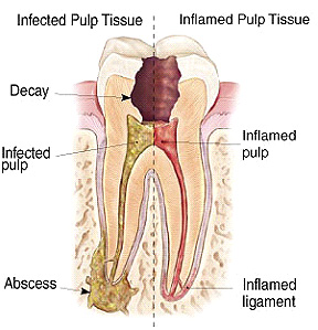 Decayed Tooth